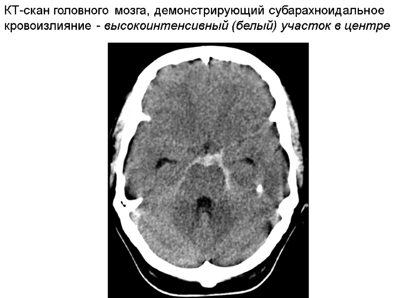 КТ-скан головного мозга, демонстрирующий субарахноидальное кровоизлияние - высокоинтенсивный (белый) участок в центре